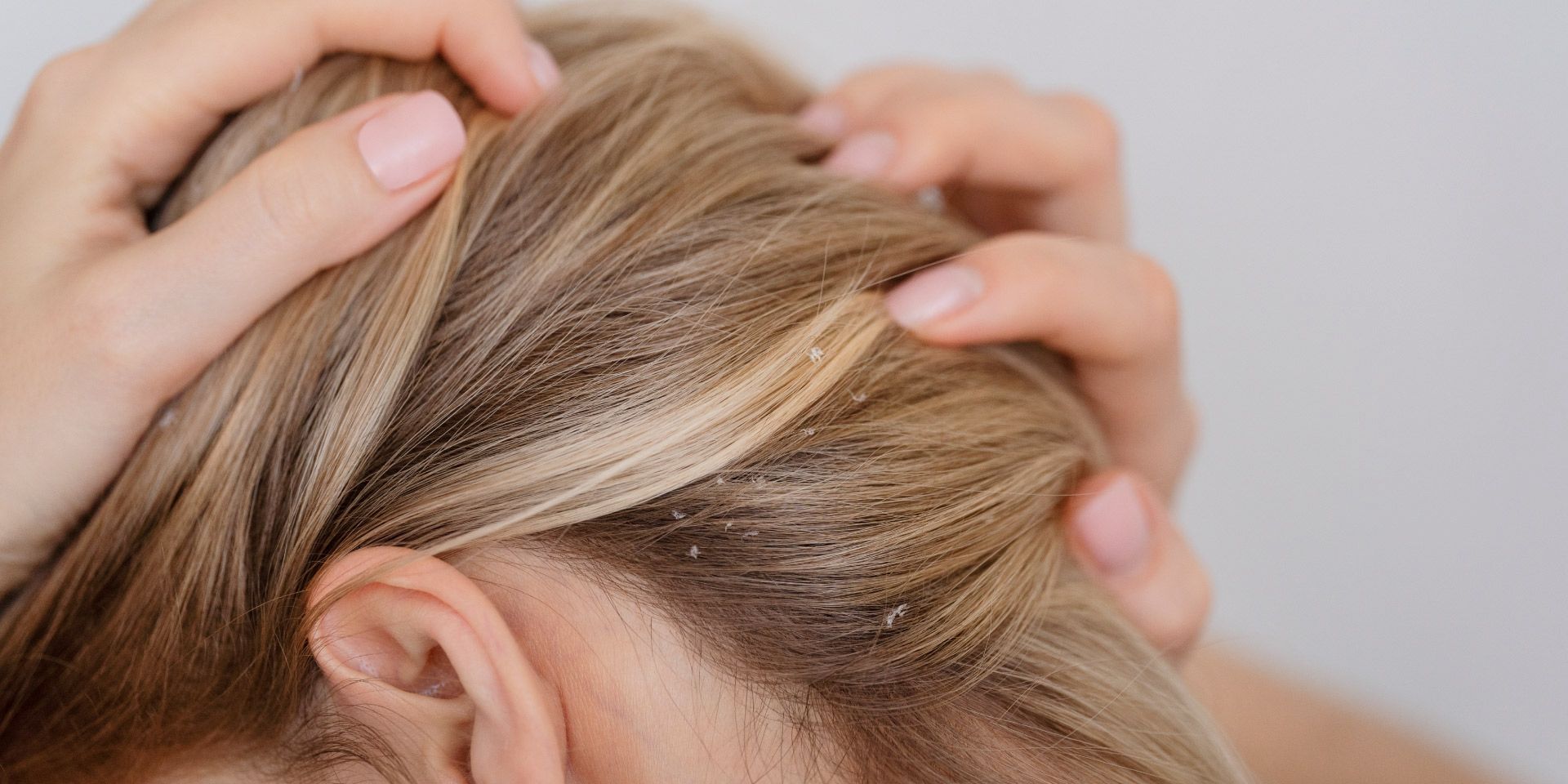 Diferenças entre caspa seca e caspa oleosa e como tratar?